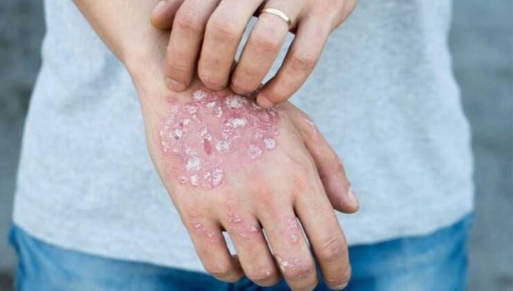 Prof. Dr. Müge Güler: ‘Artık günümüzde şanslı hasta kümelerinin başında sedef hastaları geliyor’