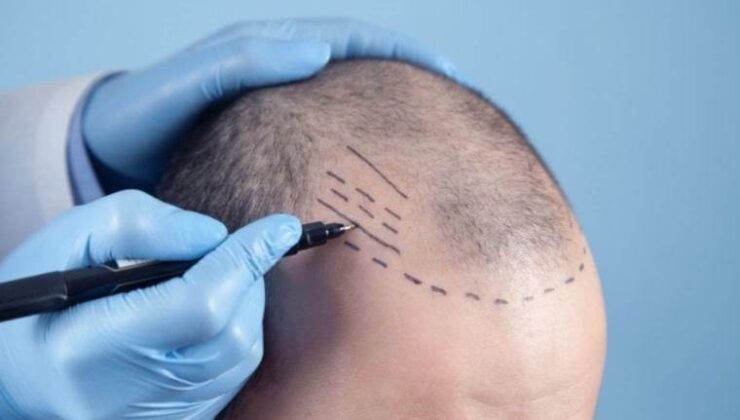 Uzmanı açıkladı: Saç ekimi süreçleri, yenilikçi teknolojiyle artık daha kısa sürüyor