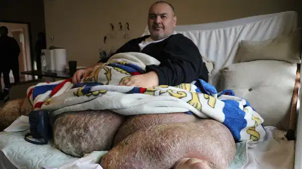 300 kiloya ulaşan fil hastası 30 kişi tarafından konutundan çıkarıldı!